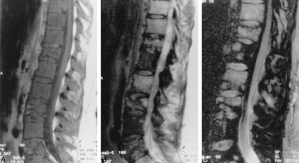 AJNR: 1, May VERTEBRAL METASTASES 951 FIG 3. Patient with diffuse involvement from an unknown primary tumor, with hyperintensity on diffusion-weighted images.