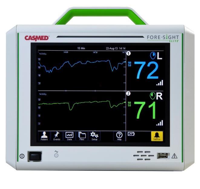 NIRS monitoring during CEA Data based on 58 patients 49 clinically stable 9 clinical deterioration (7 shunted) Easy