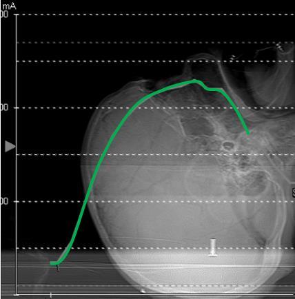 A B C Figure 9-10. Graph of tube current of Head protocol with iterative reconstruction with increasing target noise levels of A) 2.5 SD,
