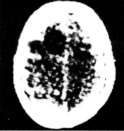 First clinical image obtained from EMI CT scanner.