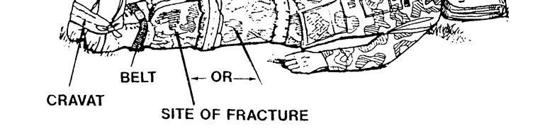 Figure 4-8. Uninjured leg used as an anatomical splint. a. Obtain Materials. You will need two rigid objects, padding, and securing materials.