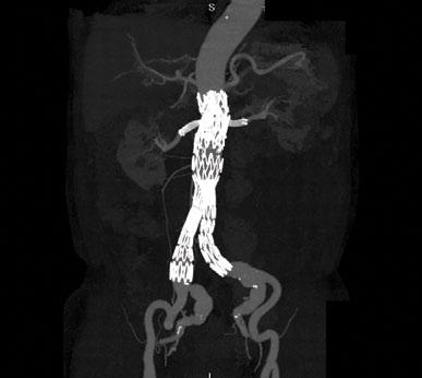 Recent research shows that standardized fenestrated designs suitable for endovascular treatment of > 70% of patients with juxta- and pararenal aneurysms currently treated with custom-made fenestrated