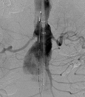 A B C D E F Figure 3. Angiography revealed a short infrarenal neck (A). A type IA endoleak can be seen after the deployment of a stent graft (B).