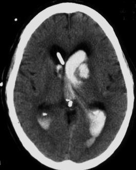 that may correlate risk of ischaemic stroke with small vessel