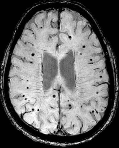 Ischaemic stroke or TIA with