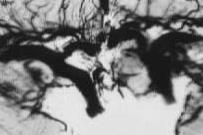 Cerebral amyloid angiopathy Ce am