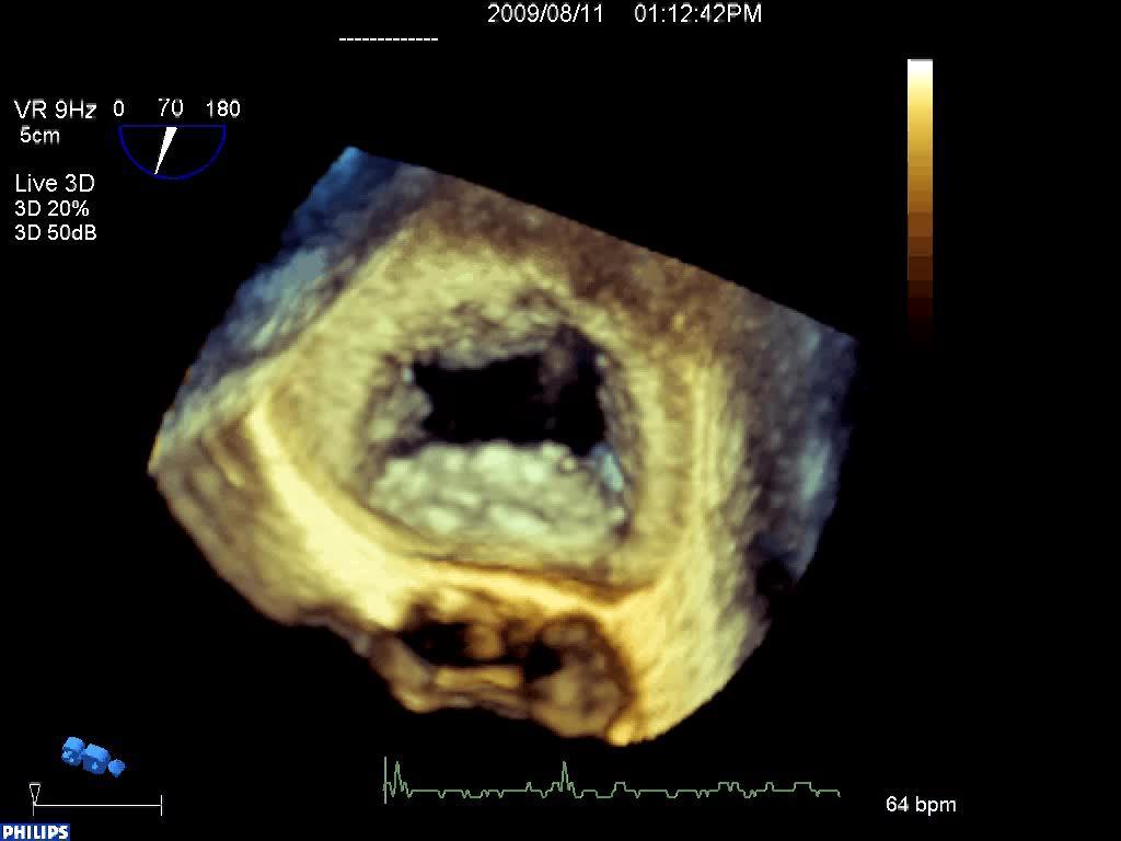 Mitral Valve by 3D