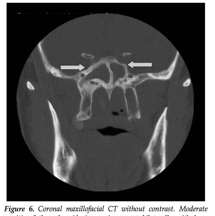 diagnose osteitis based on thickness of bony partitions in the maxillary, ethmoid, and sphenoid sinuses Lee