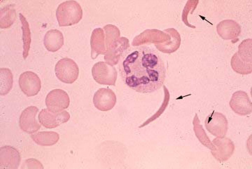 Sickle-Cell Anemia Blood