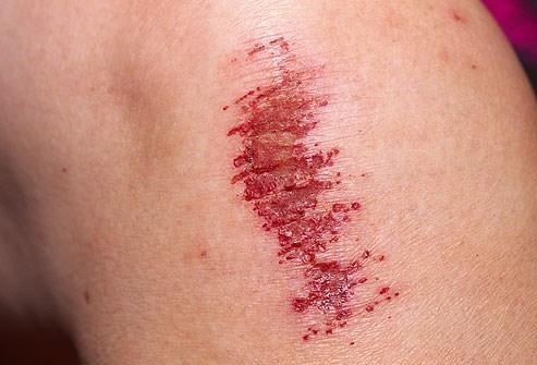 Blood Clots Fibrin forms a mesh of strands around the injury to hold the plug in place and heal the