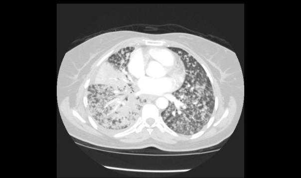 non-smokers, Asian ethnicity, adenocarcinoma (BAC) 20% patient with stable disease
