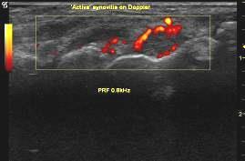US appearances: Synovial Hypertrophy and Synovitis Synovial proliferation and resulting hypertrophy is the primary event in RA that is visible on imaging Abnormal hypoechoic (relative to subdermal