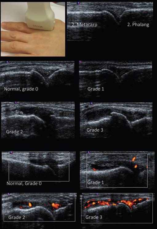Grading of synovitis Grey scale Grade 0: no synovial thickening Grade 1: minimal synovial thickening without bulging over the line linking tops of the bones Grade 2: synovial thickening bulging over