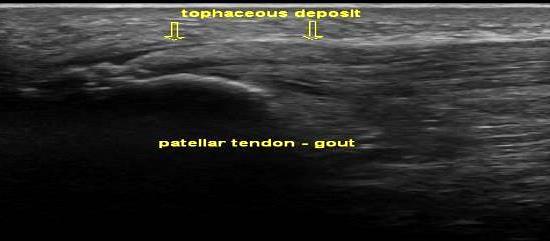 Gout - common sites 1 st MTPj/knees