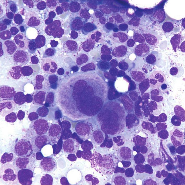 Bone marrow fibrosis has been reported in clinical trials with romiplostim [1].