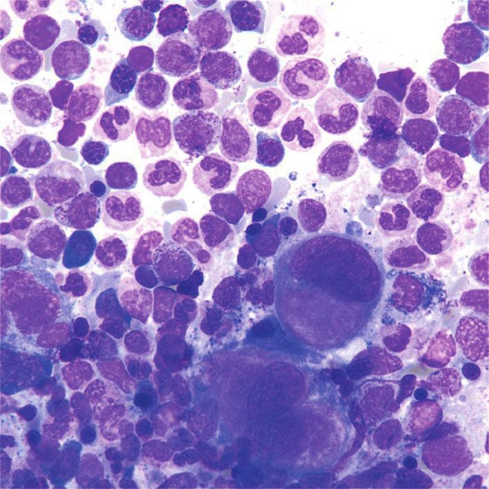 3 Figure 4: Bone marrow aspirate after treatment with romiplostim with hypolobated megakaryocytes (Wright-Giemsa, original magnification 100).