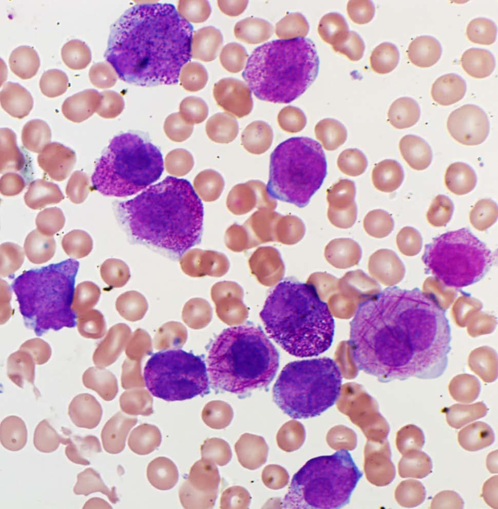 Blast cell features Acute promyelocytic