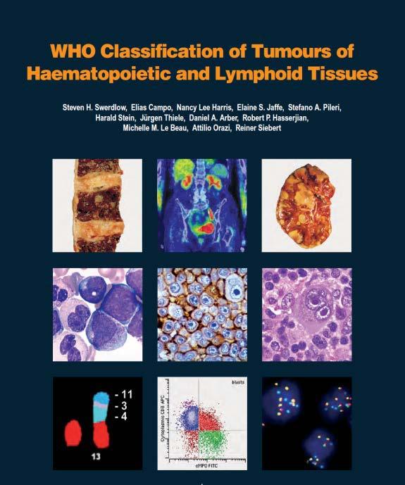World Health Organization Classification of AML Published in 2017 Acute myeloid leukemia (AML) and related neoplasms AML with recurrent genetic abnormalities AML with t(8;21)(q22;q22.