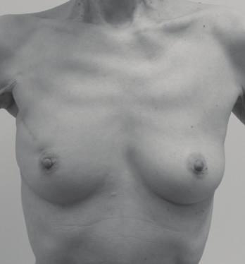 A doppler examination was performed to confirm the location of perforators from the internal mammary artery (Figure 1).