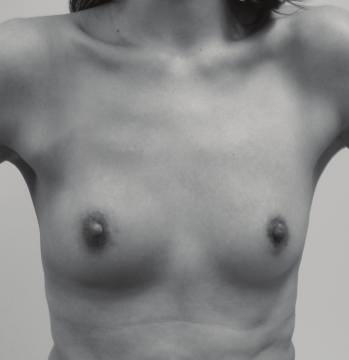 Photographs of the patient s breasts were then taken using a frontal view without any identifying features.