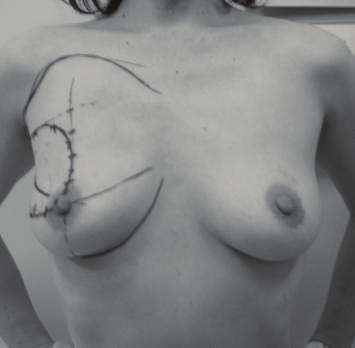 Many oncoplastic techniques have been reported, and some algorithms for selecting which oncoplastic technique to use for repairing partial mastectomy defects have been reported [1, 10 14].