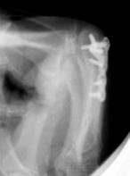 X-Rays Metacarpal Neck