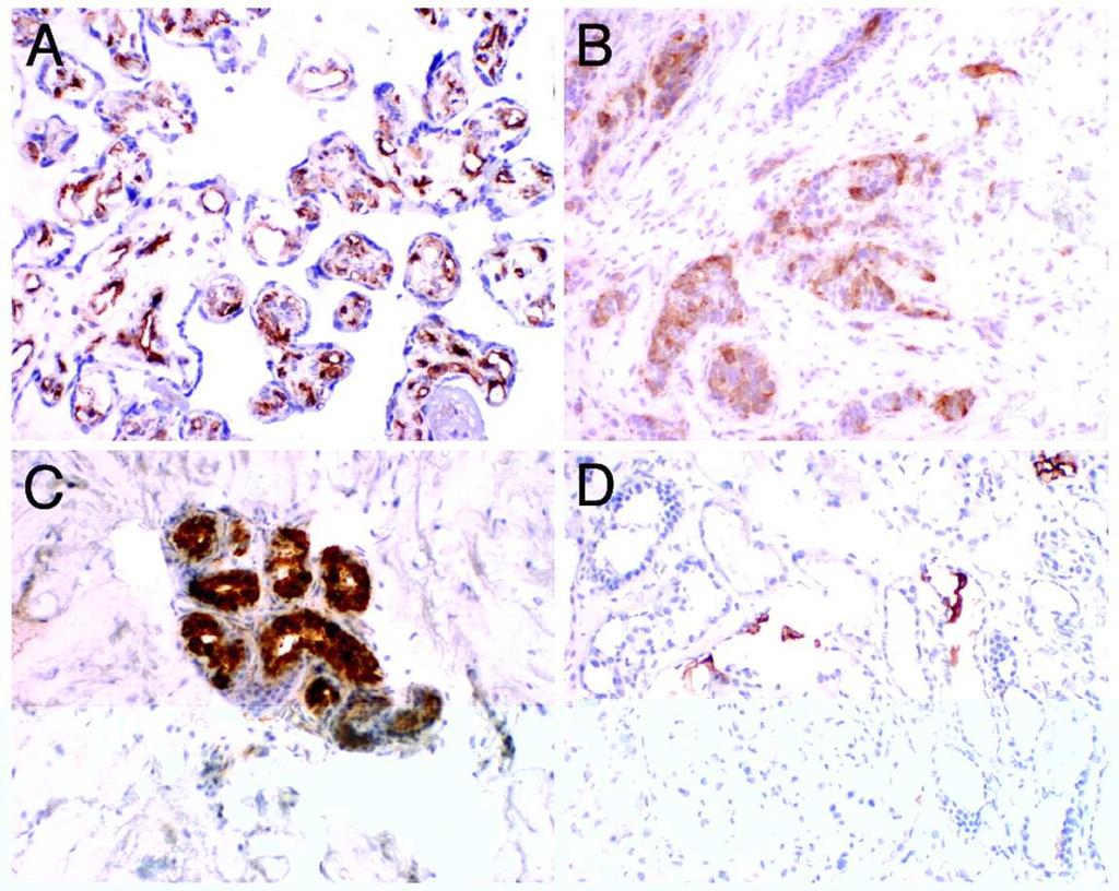 Examples of reactivity of anti-neu5gc antibody with human tissue sections blood vessels in placental villi breast carcinoma, tumor cells and blood vessel skin