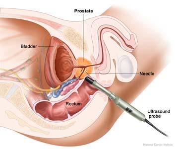 Prostate Prostate biopsy is a