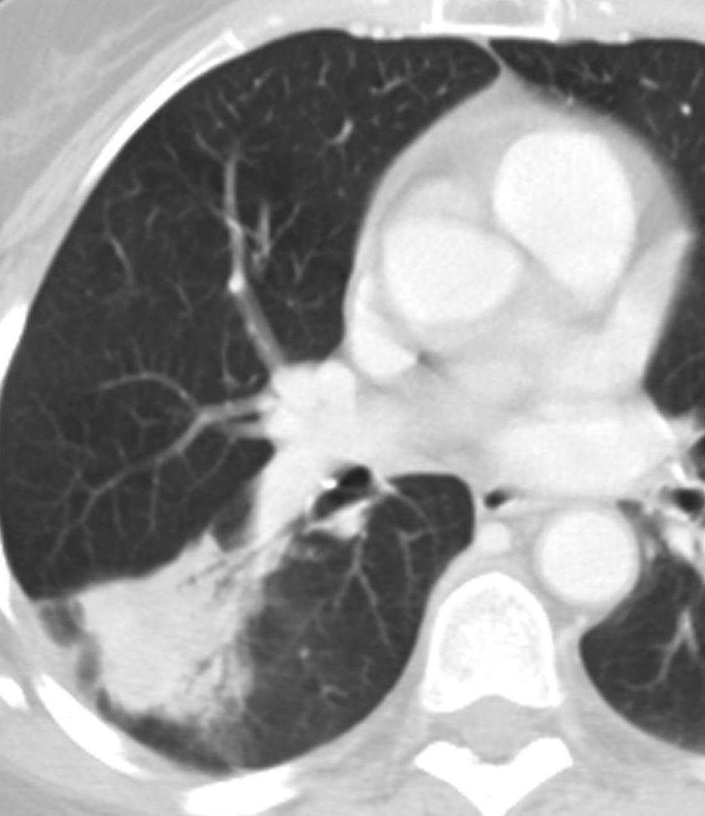 Imaging Characteristics FIGURE 3. Extensive ground glass opacity left upper lobe, with subcentimeter foci of ground glass opacity also present in the right upper lobe. FIGURE 1. location. FIGURE 2.