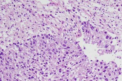 Metastasis Metastatic non-small cell carcinoma