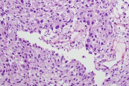 Metastasis Small cell carcinoma
