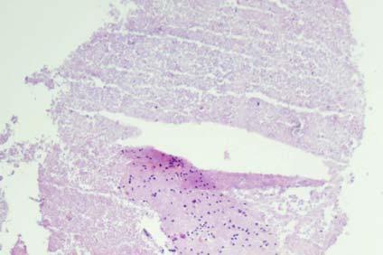 shows diffuse necrosis or minimal semi-viable tumor.