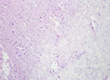 Parenchymal infarcts Small circumscribed foci of severe edema with axonal loss or overt necrosis