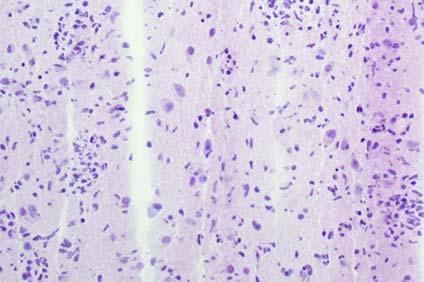 atypia Cells with round nuclei?