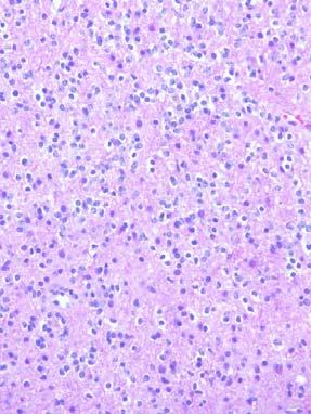 diffuse glioma (Oligo/Astro) p53 Widely expressed tumor suppresser gene/pathway p53 mutation or other defect in p53 pathway leads