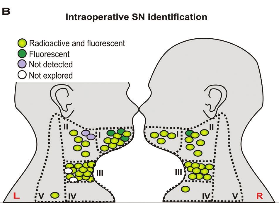 CHAPTER 4 Figure 4. Schematic overview of primary tumor location and the intraoperative sentinel node identification results. A) Primary tumor location; B) Intraoperative SN identification method.