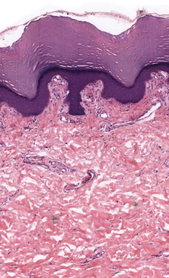 Dermal papillae Papillary dermis Reticular dermis Dense connective tissue