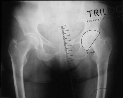 PRE-OPERATIVE TEMPLATING The primary goal of total hip arthroplasty is the anatomic reconstruction of the hip joint, resulting in favourable prosthetic joint load and function.