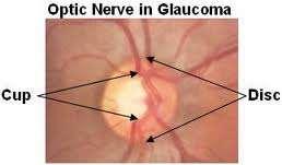 Glaucoma 23 Treatment 40% compliance Suppress aqueous