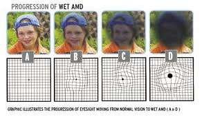 Presentation Dry blurred vision, central scotoma Wet central scotoma, image distortion, increased