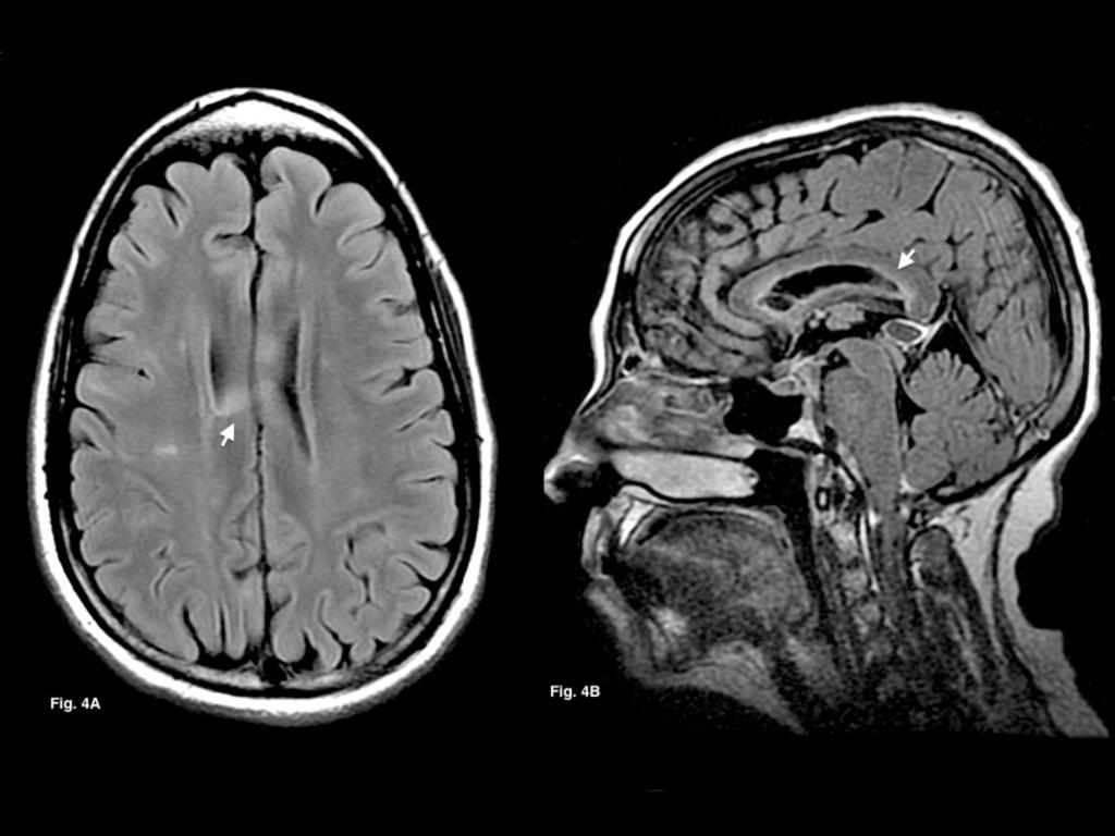 Fig. 4: A: 27 years old female patient with NMOSD. Axial FLAIR T2WI shows focal hyperintense lesions within corpus callosum s body.