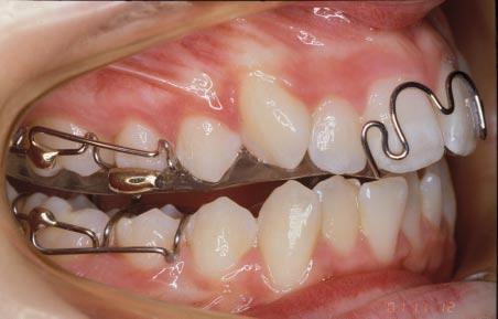 appearance is to be achieved for the patient. Harmonized skeletal bases need less tooth movement and, in particular, less incisor root movement to produce the dental correction.