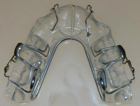 Mandibular advancement, produced by vertical spring projections in the first molar area that engage lingual shoulders on the mandibular component (Fig. 3).