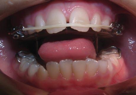 The spring action of the vertical projections acts as a stress breaker, but permits lateral mandibular movements. 4.