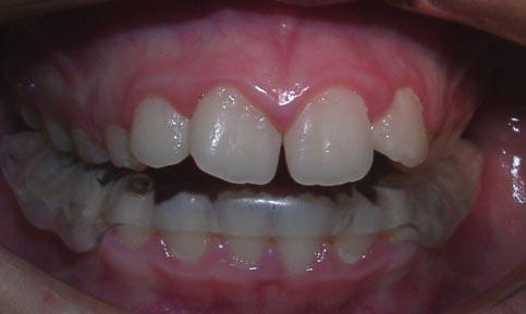 Capping the lower incisors is helpful to improve retention and to control tipping of these teeth (Fig. 8).