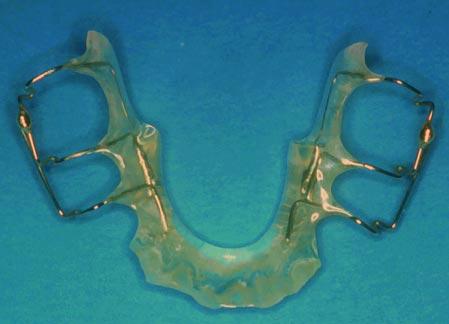 A pull-down design can also be used, with capping of the buccal segments to provide retention. 2.