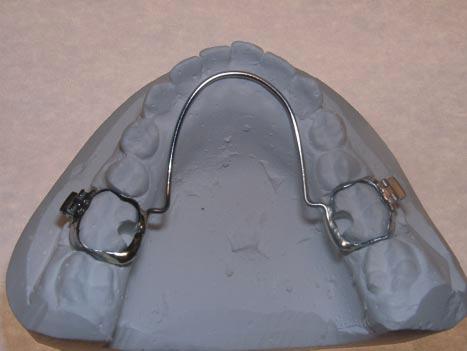 Bass and Bass Fig. 11 Fixed lingual arch cemented to bands on lower first molars, with shoulders bent into wire mesial to bands. Appliance Construction *Dynamax (UK) Ltd., 4 Queen Anne St.