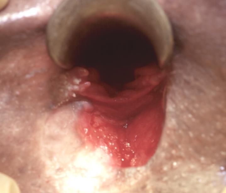 ANAL FISSURE Location & appearance Idiopathic Atypical