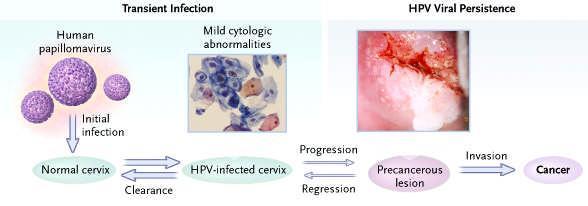 HPV INFECTION Low risk and high risk HPV High
