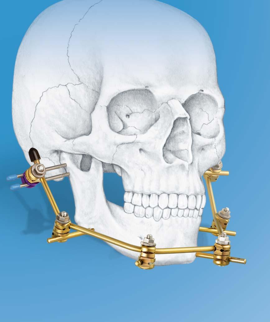 Mandible External Fixator II. Provides treatment for fractures of the maxillofacial area.